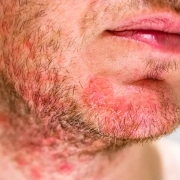 Dermatite seborroica nei bambini e negli adulti: come riconoscerla?