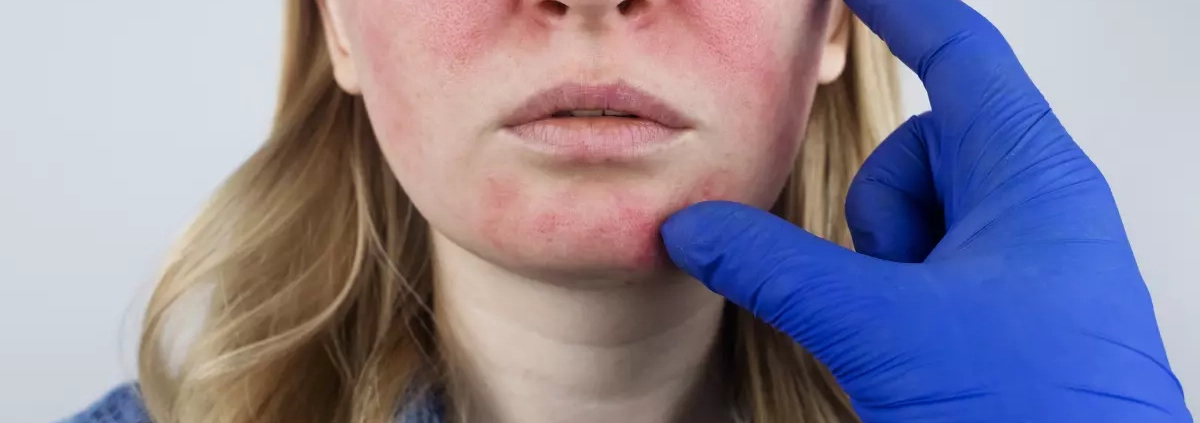 Rosacea, ecco come prendersi cura della pelle
